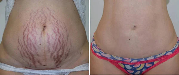 SkinFix™ Spray para Cicatrices