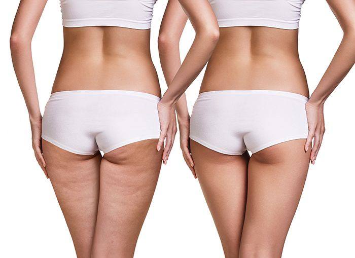 Crema Anticelulitis 4D